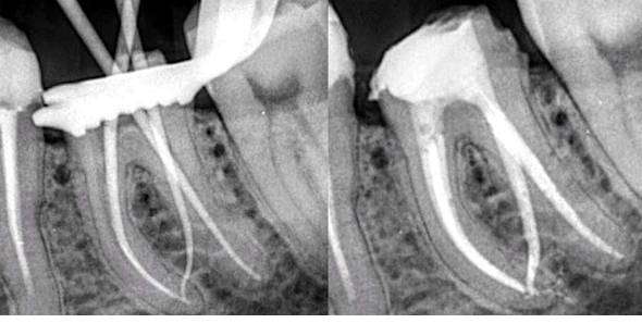 endodoncista azcapotzalco
