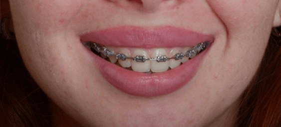 ortodonciadespuespng
